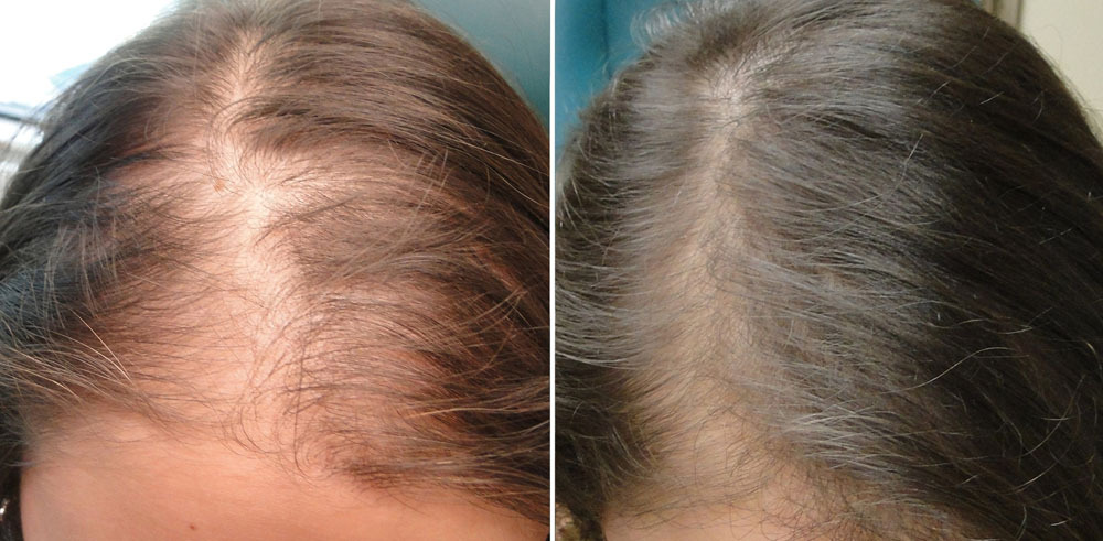 Wie Lange Dauert Die Haar Mesotherapie?